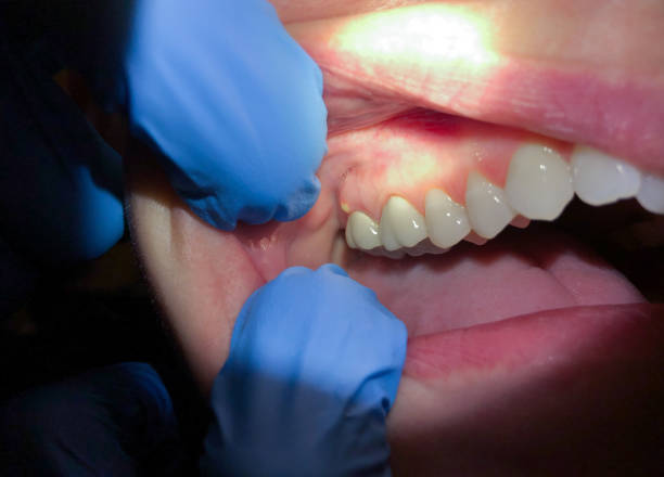 Best Dentist for Tooth Abscess  in Shasta Lake, CA